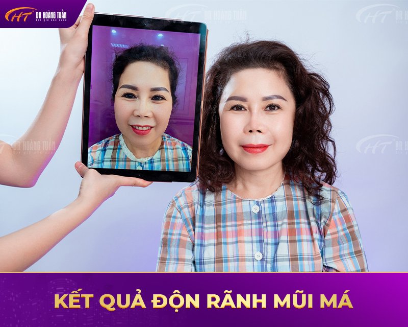 Một số kết quả độn rãnh mũi má tại Dr Hoàng Tuấn 1